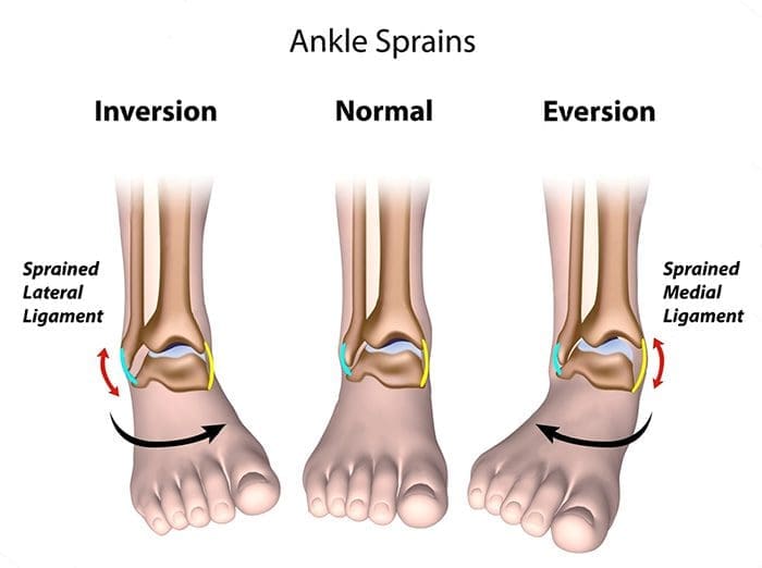 sprain and strain treatment - injury medical and chiropractic rehabilitation el paso, tx.