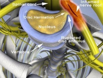 Hernia discal quiropráctica de alivio el paso tx.