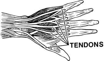 tendinosis