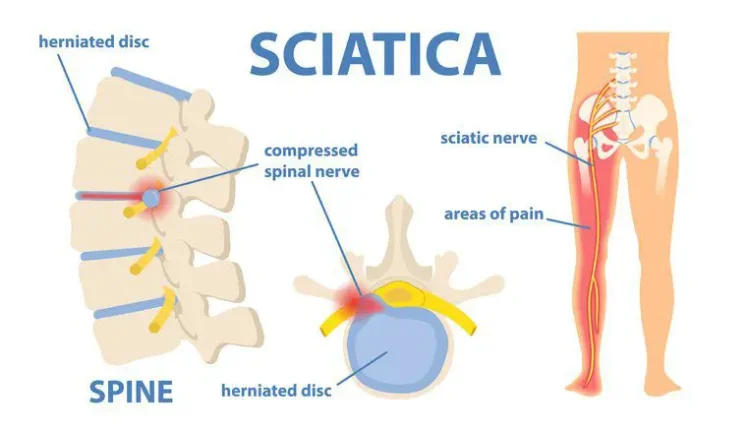 Integrative Sciatic Nerve Rehab for Pain Relief